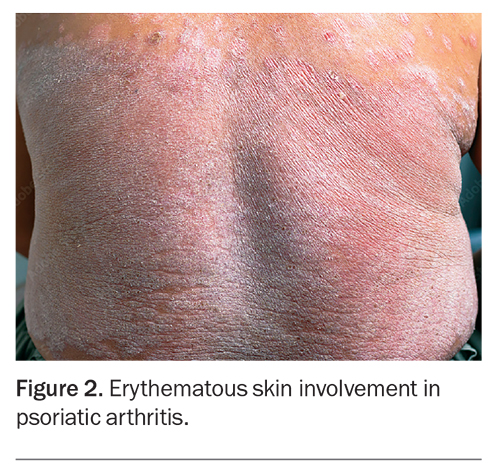 Psoriatic Arthritis: How Early Recognition Helps Management | Medicine ...